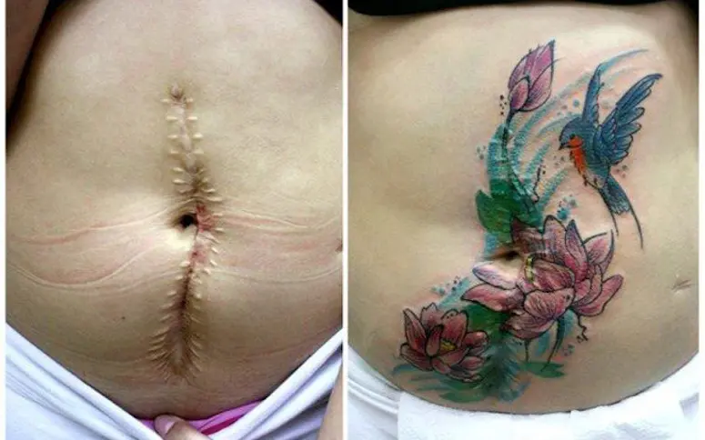 Des tatouages pour recouvrir les cicatrices de femmes victimes de violence
