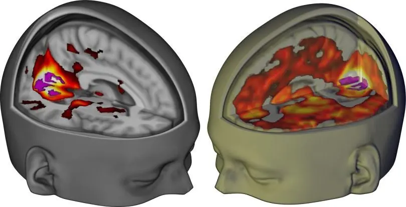 Des scientifiques révèlent en images les effets du LSD sur le cerveau