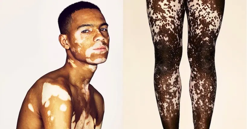 La beauté des personnes atteintes de vitiligo sublimée sous l’objectif de Brock Elbank