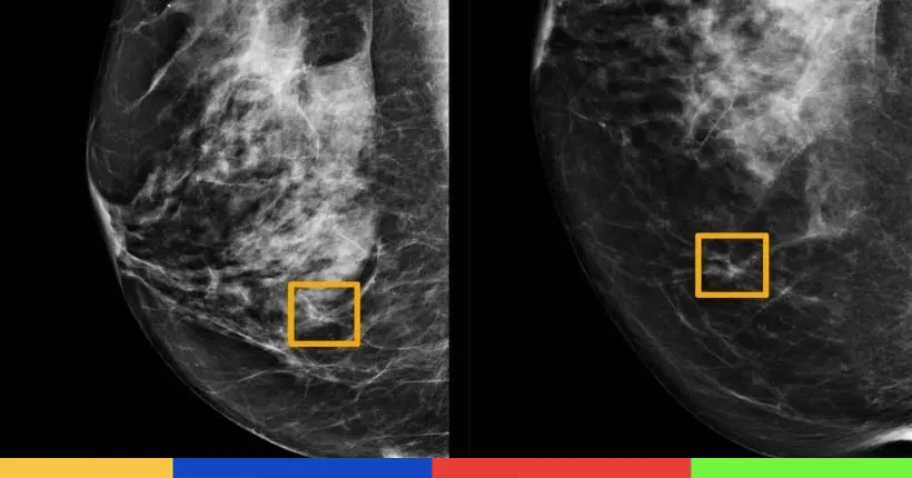 Pour la première fois, une IA a battu les radiologues pour détecter le cancer du sein
