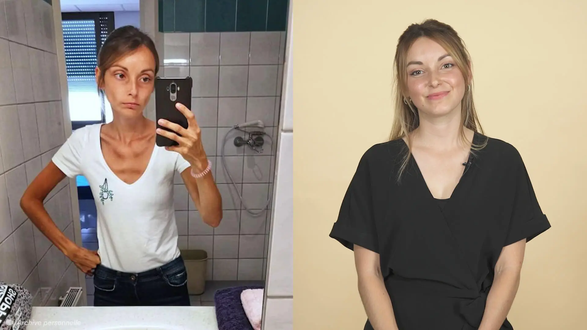 Vidéo : Ma longue bataille contre l’anorexie