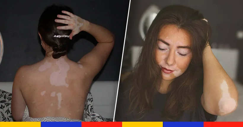 Justine, atteinte de vitiligo depuis 13 ans : “Je ne suis pas un monstre”