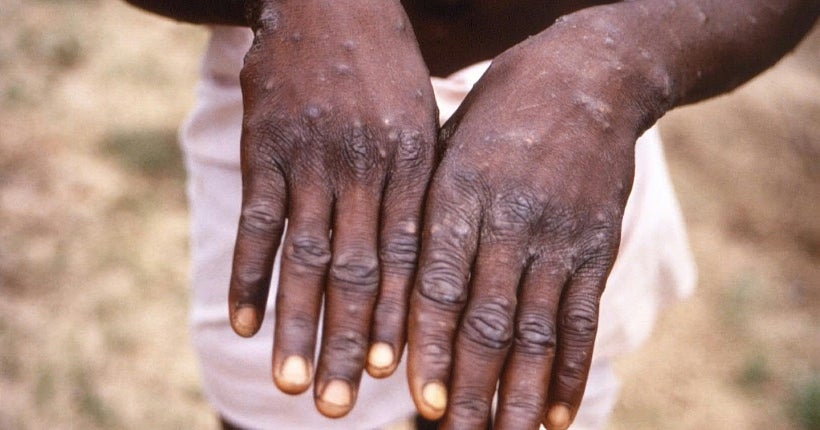 Un homme contaminé par la variole du singe est mort en Inde