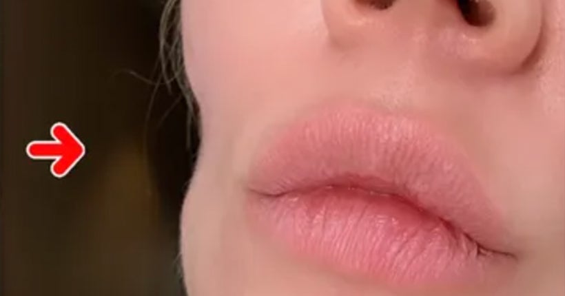 Khloé Kardashian parle ouvertement de son cancer de la peau et des cicatrices au visage qu’elle en a gardé