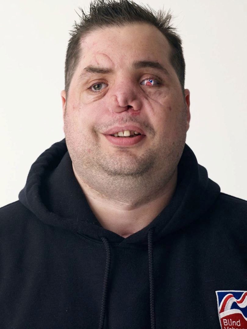 Le caporal Simon Brown, 28 ans, blessé d'une balle de sniper en 2006 et aveugle depuis. Il porte une lentille aux couleurs de l'association d'anciens combattants Blind Veterans UK
